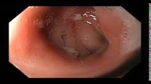 anastomotic ulcer following gastric