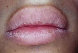 dry lips with scaling and crusting