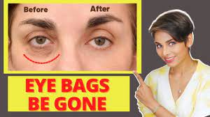 bags under your eyes naturally