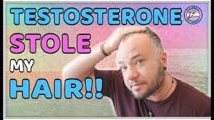 my hair testosterone and hair loss