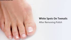 white spots on toenails after removing