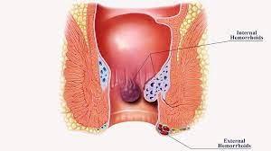 Your thrombosed internal hemorrhoid may look a bit like this hemorrhoid in this photo below, note the tight hard swollen look, how enlarged it has become: What Are Hemorrhoids Symptoms Causes Diagnosis Treatment And Prevention Everyday Health