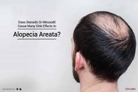 side effects in alopecia areata