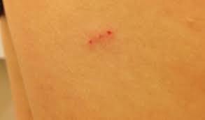 bite marks prevention of bite marks