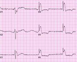 55 year old male with altered mental status, hypothermia, and Osborn waves  - ACLS Medical Training