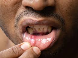 mouth sores pictures causes types