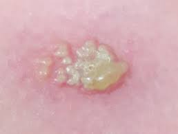 Overview hsv infections can be very annoying because they can periodically reappear. Herpes Simplex Dermnet Nz