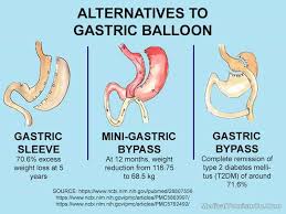 alternatives to intragastric balloon procedure weight loss