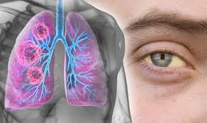 A cancer can grow into,or begin to push on nearby organs, blood vessels, and nerves. Lung Cancer Symptoms Signs Of A Tumour Include Yellow Eyes And Jaundice Express Co Uk