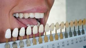 Teeth Color Chart Utodent Com