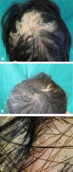 It is available as foam, shampoo, cream, gel, lotion, ointment, solution, and spray. Clinico Dermoscopic Features Of Alopecia Areata In Patients With Psoriasis Jaad Case Reports