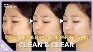 The product is a dermatologist favorite, and it's super affordable. Wish Pick Top 5 Korean Products For Oily Acne Prone Skin