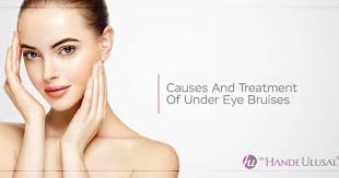 treatment of under eye bruises