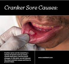 kick out canker sores understanding