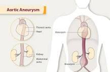 Image result for what is the icd 10 code for abdominal aortic aneurysm