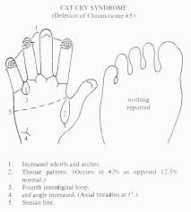4 Hand Charts For Cri Du Chat Syndrome