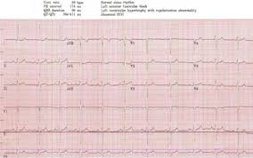 Cardiac Arrest In A Softball Player