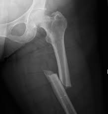 fem shaft fractures the bone