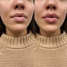 lip fillers injections upper east