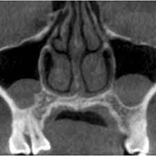 mucous retention cysts