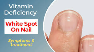 white spots on nails vitamin deficiency