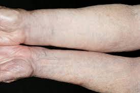 swollen arms and hands oedema nhs