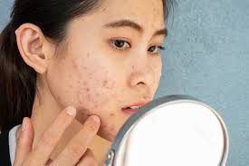 can pregnant women use acne wash