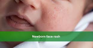 worried about your newborn face rash