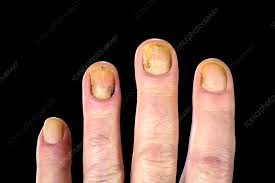 dystrophic finger nails stock image
