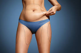 weight can you lose with liposuction