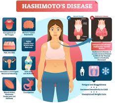 hashimoto hair loss how to stop it
