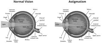 can you get lasik with an astigmatism
