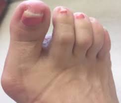 vicks vapor rub toenail fungus foot