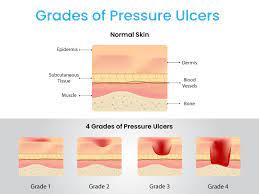 epuap pressure ulcer grading system