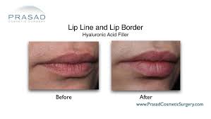 how to avoid bruising after lip fillers