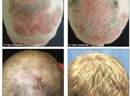 treating alopecia universalis with