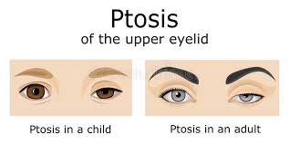 Illustration Of Ptosis Of The Upper Eyelid Stock Vector