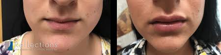 1 syringe juvederm for young italian