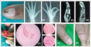 glomus tumour of hand a commonly
