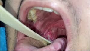 mucosal lesions during sars cov 2