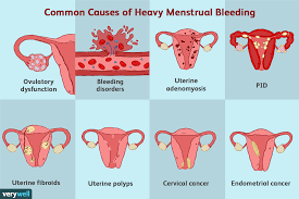 heavy menstrual bleeding menorrhagia