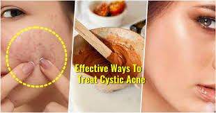 treat cystic acne easily