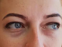 under eye swelling puffy eyes causes