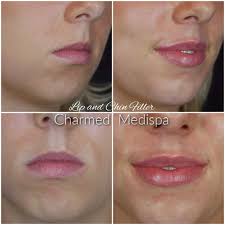 lip filler treatment charmed spa