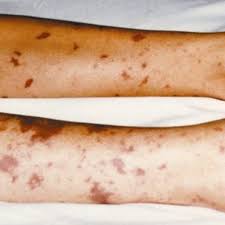 Some may not appear at all. Meningitis Symptoms Treatment Causes Rash Pictures Hubpages