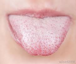 what causes a white tongue with pictures