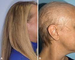 chemotherapy induced alopecia