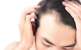 Receding Hairline: Stages, Causes, Treatments & More | Metropolis TruHealth Blog