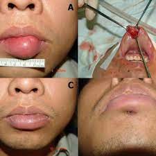 pdf epidermal cyst on the lower lip
