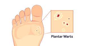 treatment and removal of plantar warts
